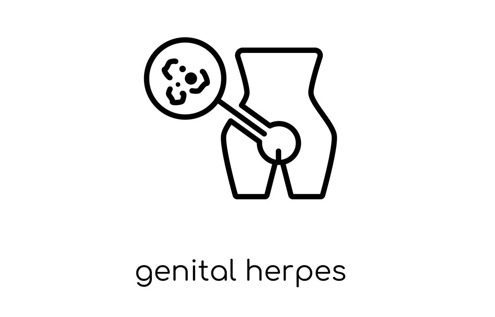 Herpes simplex virus i underlivet (Genital Herpes).