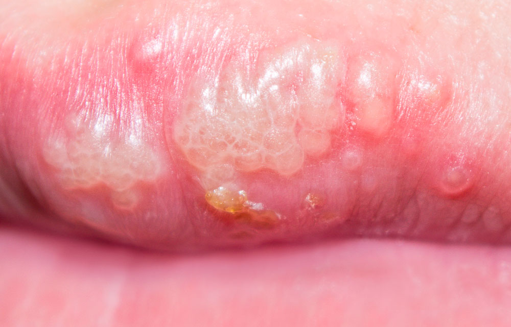På læben ikke forkølelsessår sår Forkølelsessår (herpes)